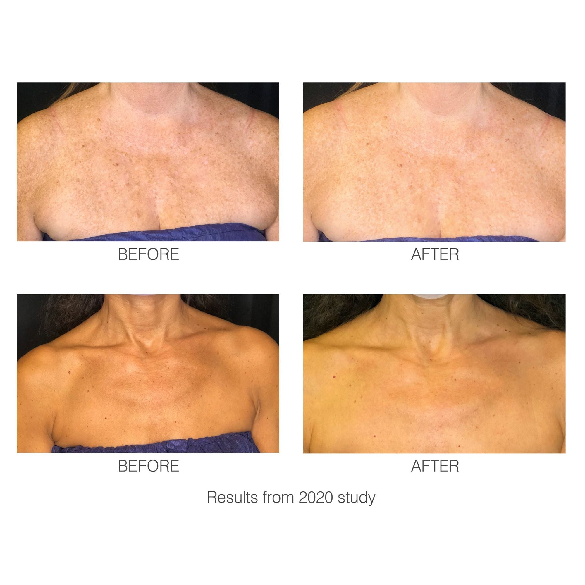 2/2 - 2020 Study - Before and after images showing how the decoLITE LED light treatment soft-fit mask has improved the look of wrinkles and pigmentation.